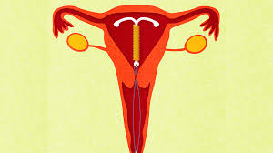 I have a high deductible and i am interested in the merina or paragard. When Is It Ok To Get Your Iud Removed Self