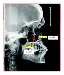 Image result for Maxillary Sinus