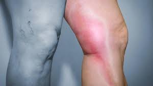 Clotting is normal, but clots can be dangerous when they do not dissolve. 6 Things To Know About Blood Clots