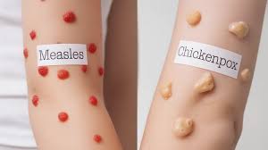Image result for measles