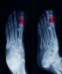 Image result for toe amputation