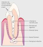 Image result for icd 10 code for infected tooth