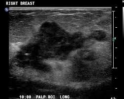A specialist looks at the ultrasound pictures. Breast Pathology Ultrasound