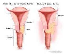 Simptom dan tanda selalunya berlaku apabila kanser telah menjadi lebih teruk ataupun merebak. Gejala Kanker Serviks Penyebab Biaya Berobat Dokter Smarter Health
