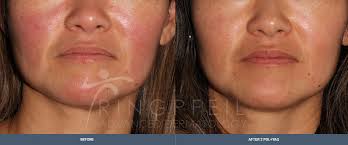 Side effects are usually minimal and may include temporary redness, loss of skin color and bruising. Rosacea Treatment Philadelphia Main Line Pa