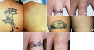 Many factors influence the number of treatments needed including the size of the treatment area, the colors in the tattoo, if the ink is layered, a person's skin tone, and among others. Kim S Permanent Cosmetics Photo Gallery Laser Tattoo Removal