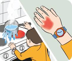 First Aid For Burns Scalds In Pictures Raising Children Network As we know first aid is a need of every person in the world, this box is too much helpful for sudden wound and minor injuries. first aid for burns scalds in
