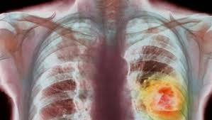 Tratament de cancer la plamani. Sarcoidoza PulmonarÄ Diagnostic Èi Tratament Simptome Pulmonare Èi Tratament