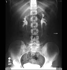 Intravenous Pyelogram Ivp Is An X Ray Exam That Uses An Injection Of Contrast Material To Evaluate Your Kidneys Ureters And Bladde Intravenous Renal Bladder