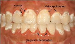 White Spot Lesions Cavities Upper Dentition And Gingival Download Scientific Diagram