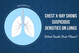 List of 1 apico definition. Chest X Ray Shows Suspicious Densities On Lungs What Could That Mean Respiratory Tract Disorders And Diseases Articles Body Health Conditions Center Steadyhealth Com