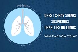 We did not find results for: Chest X Ray Shows Suspicious Densities On Lungs What Could That Mean Respiratory Tract Disorders And Diseases Articles Body Health Conditions Center Steadyhealth Com