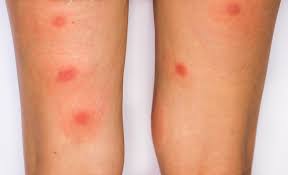 Image result for Papular urticaria