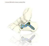 Some Knowledge of Calcaneal Ankle Locking Plate