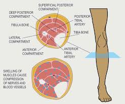 Image result for Compartment Syndrome