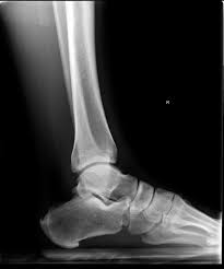 Special views may be taken if there is concern for a fracture of the calcaneus. X Ray Of My Foot My Achilles Tendon