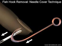 Image result for Fishhook Removal