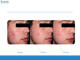 If you have moderate, consistent acne, accutane is an option for you! Exhibit 99 1 Htm
