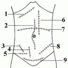 1 Kocher Incision 2 Midline Incision 3 Mcburney Incision 4 Battle Incision 5 Lanz Incision 6 Paramedian Incision 7 Tran Abdominal Anatomy Learning Tools