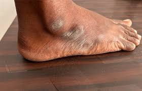 Image result for brown patches on the feet
