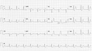 Page one contains the limb leads, and page two shows us the precordial leads. Stemi Equivalents Can T Miss Patterns Emra