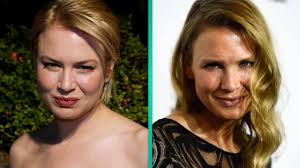 What Did Renee Zellweger Do to Her Face? Plastic Surgeon Weighs In