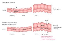 Image result for Lactase Deficiency