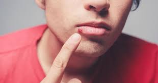 Como Curar Las Ampollas En Labios De Manera Casera