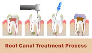 More images for root canal care after procedure » When Do You Need A Root Canal Treatment Procedure Step By Step