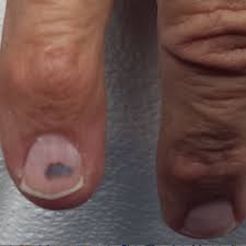 Melanoma is a type of cancer that develops in cells called melanocytes. Subungual Lesion Hasn T Grown Out Benign Or Malignant Clinician Reviews