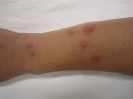 Bed bugs are also known to survive in temporary or alternative habitats, such as backpacks and under the. Bed Bug Bites Houseman Pest