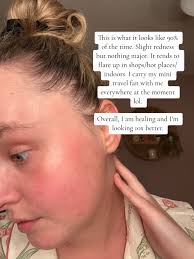 Face Psoriasis Night Routine