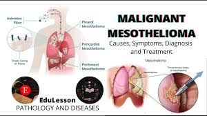 The five year survival rate for mesothelioma is approximately 6.3%. Malignant Mesothelioma Causes Symptoms Diagnosis Treatment Mesothelioma Malignant Pathology Youtube