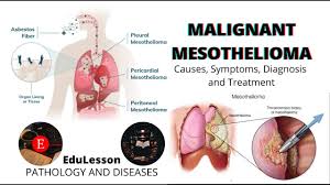 The aim of this paper is to present a case of this rare . Malignant Mesothelioma Causes Symptoms Diagnosis Treatment Mesothelioma Malignant Pathology Youtube