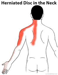 Pin On Neck Back Pain Treatments
