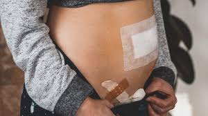Ein vorhandenes pflaster können sie nach 24 stunden entfernen. Wie Es Mir Nach Meiner Endometriose Operation Geht Lea Kreissl