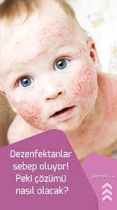 Atopik Dermatit Egzama Nedir Egzama En Kolay Nasil Gecer Sac Ve Cilt Egzamasi Sac Bebek Guzellik