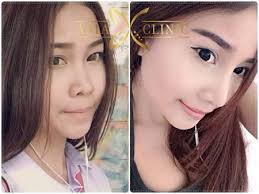 The Best Nose Augmentation Rhinoplasty In Thailand Dr Tanongsak Rhinoplasty clinics in bangkok at the best price. the best nose augmentation rhinoplasty