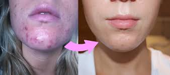 Produit prix par défaut rating. Faites Disparaitre Vos Cicatrices D Acne Avec A Ces Remedes 100 Naturels