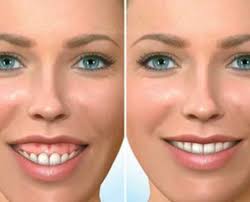 Maybe you would like to learn more about one of these? How To Fix A Gummy Smile Ultimate Guide To Gummy Smile Reduction