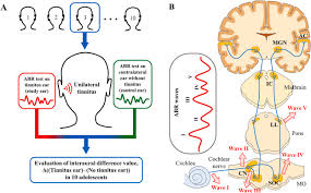 For most people the condition is just annoying but for others it can know that there can also be no cause. Auditory Brainstem Response Test Results In Normal Hearing Adolescents With Subjective Tinnitus Sciencedirect