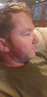 Raccoon eyes and sunburnt noses! Send us your fried pics.