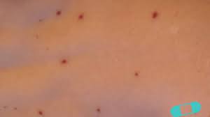 Guia De La Piel Manchas Y Sarpullidos Causados Por Virus