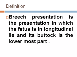 Image result for Breech Presentation