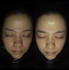 FQ祛痘印大魔王面贴补水清洁术后可用5贴