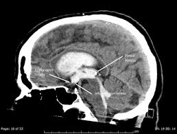 Third Ventricle Radiology Reference Article Radiopaedia Org