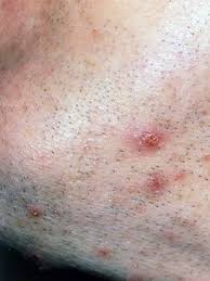 Portuguese english english portuguese german english english german dutch english english dutch Cyst On Shoulder Skin Cysts Lumps Bumps Everyday Health