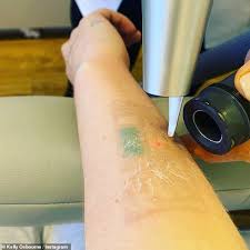Laser hair removal is safe, but there isn't enough research to know if it's safe for the unborn baby. Kelly Osbourne Shares A Glimpse At Her Laser Tattoo Removal For Three Of Her Inks Aktuelle Boulevard Nachrichten Und Fotogalerien Zu Stars Sternchen