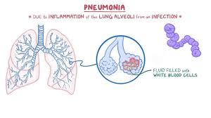 Image result for Pneumonia