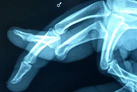 Learn how this injury is managed by reading here. Dislocated Finger What To Do Plus Symptoms Causes And Treatment